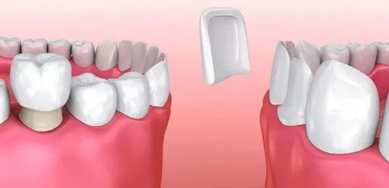 Licówki czy korony — co lepiej wybrać do Hollywood Smile w Turcji?